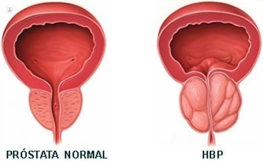 hiperplasia benigna de prostata